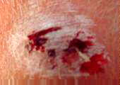 Skinned knee